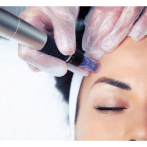 Microneedling